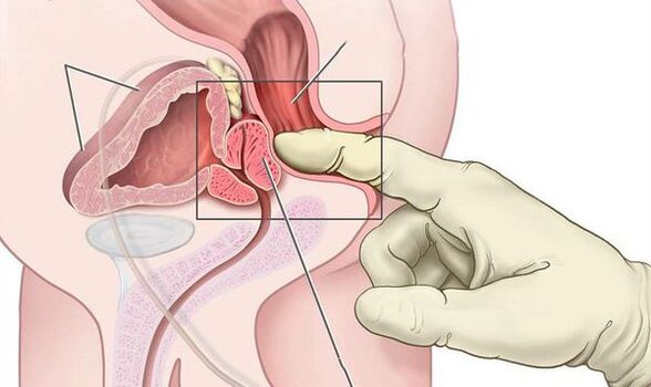 前列腺直肠指检